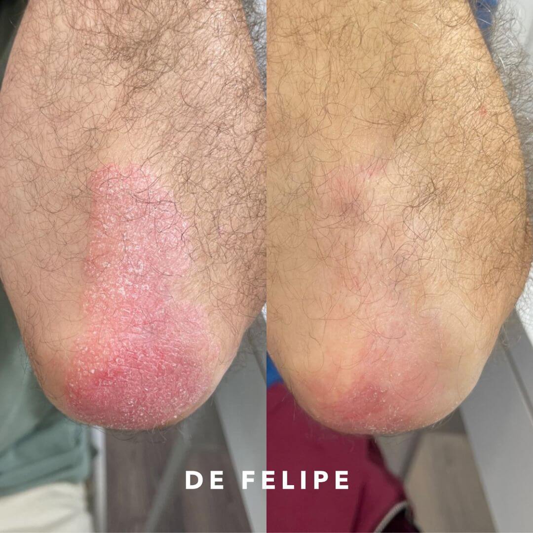 AD – Psoriasis